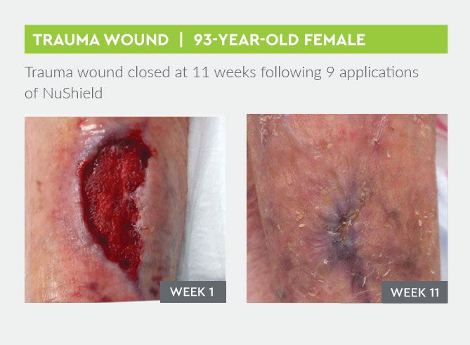 Trauma wound closed at 11 weeks following 9 applications of NuShield